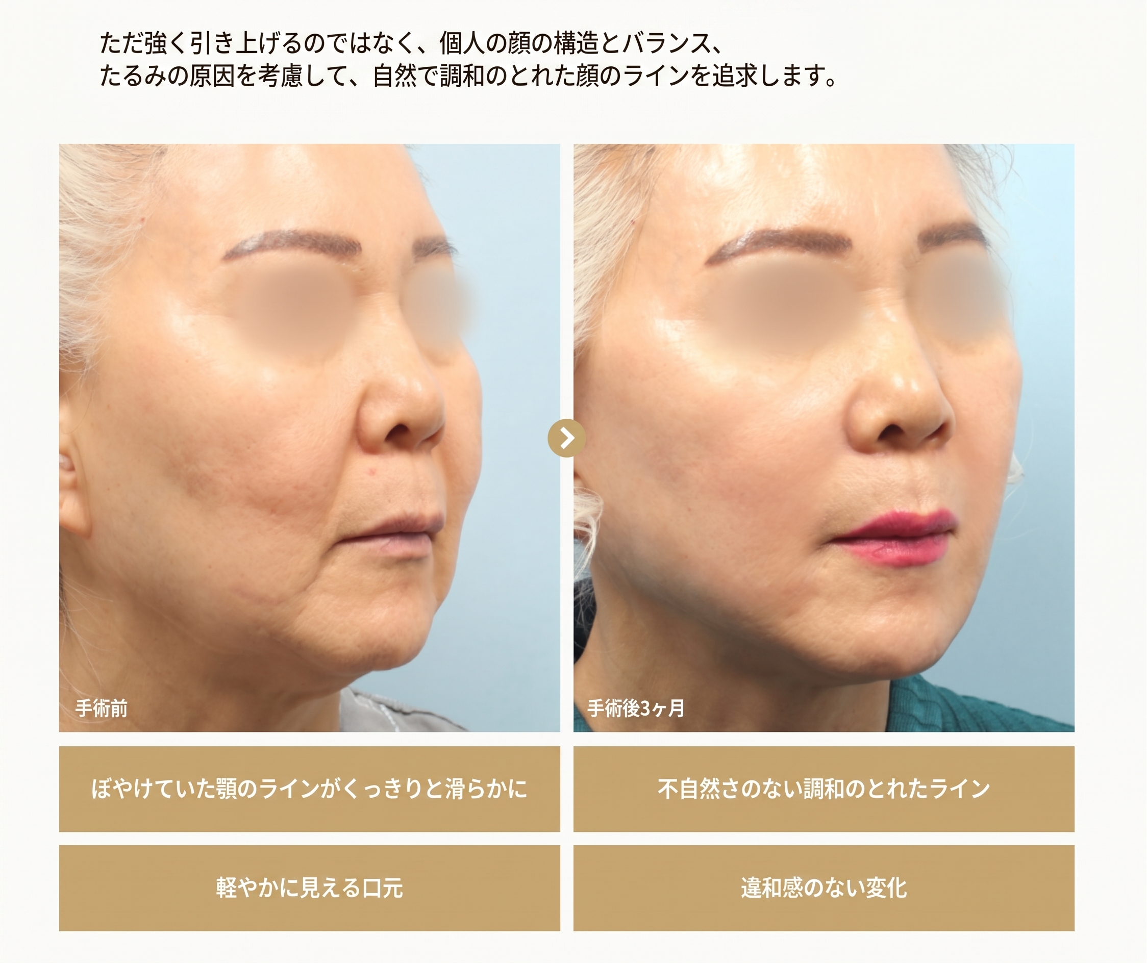 1mm(イルミリ)美容外科 フェイスフィットミニリフト 사진 5