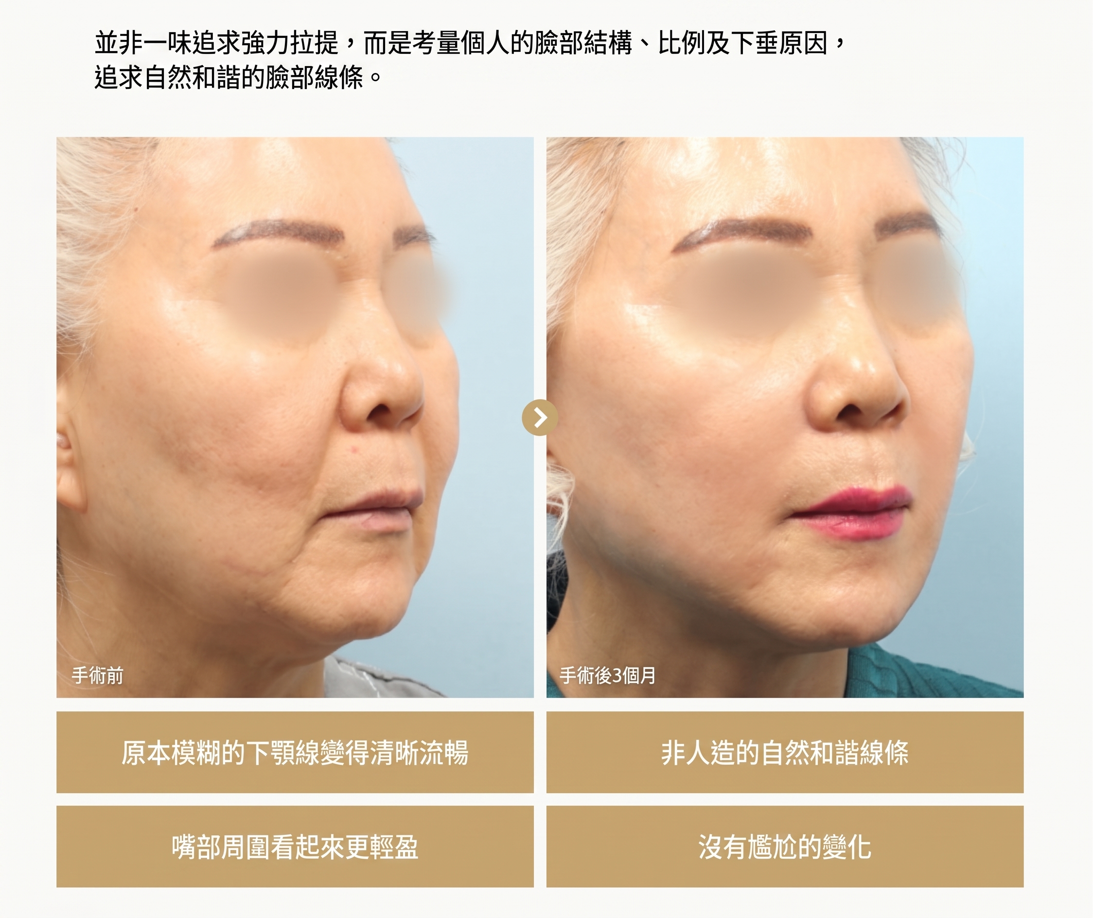 1mm整形外科 Facefit 微創拉皮 사진 5