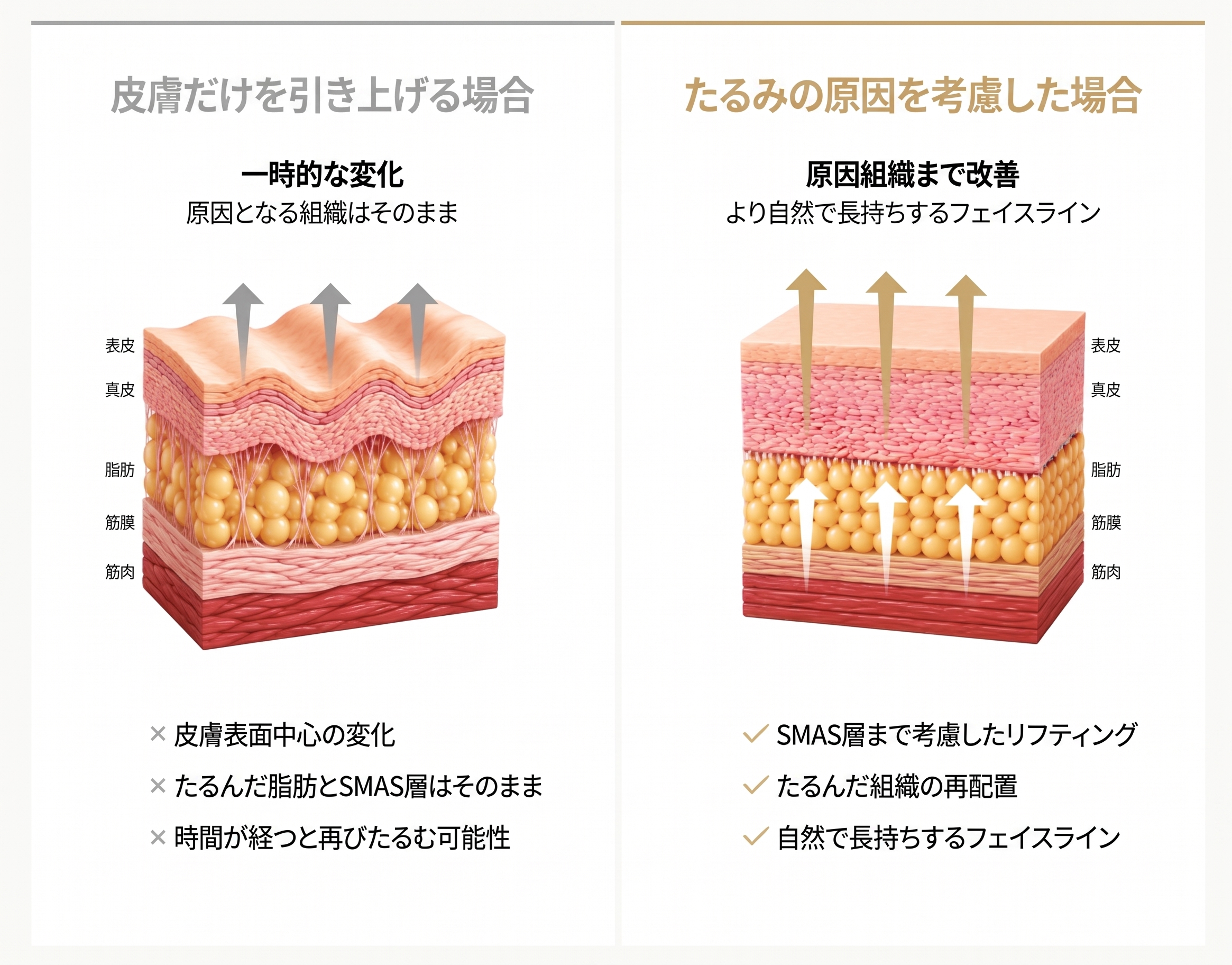 1mm(イルミリ)美容外科 フェイスフィットミニリフト 사진 4