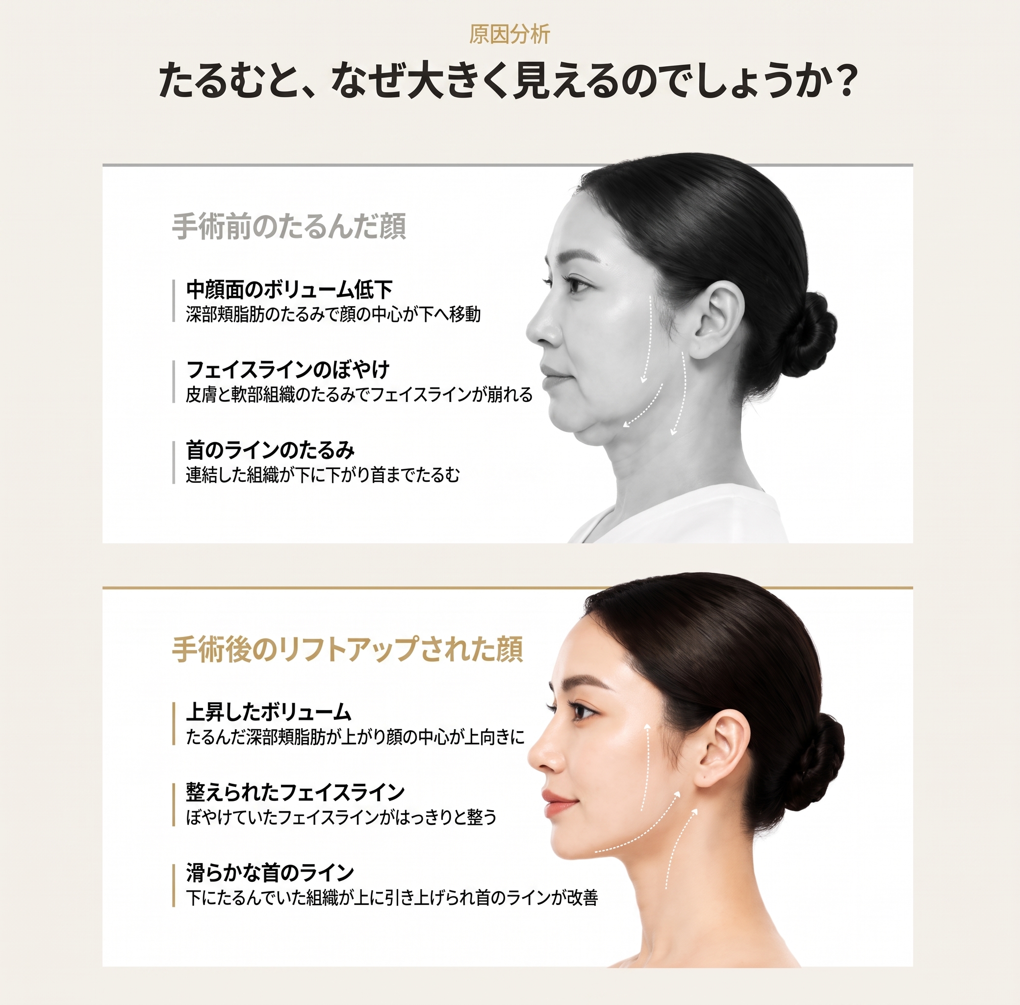 1mm(イルミリ)美容外科 フェイスフィットミニリフト 사진 2