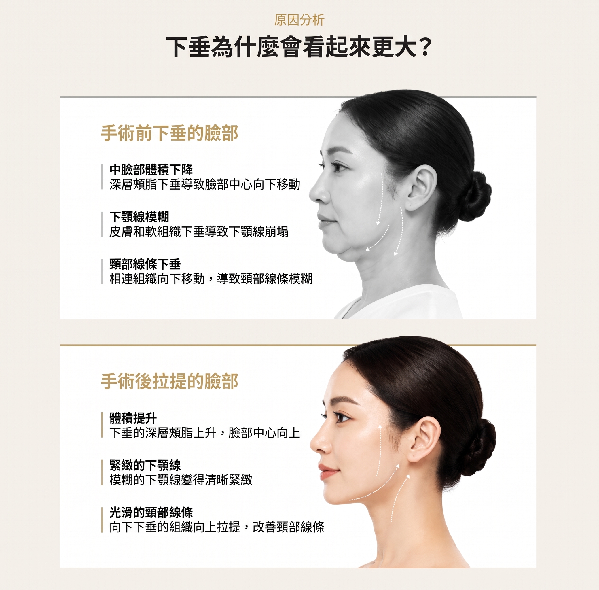 1mm整形外科 Facefit 微創拉皮 사진 2