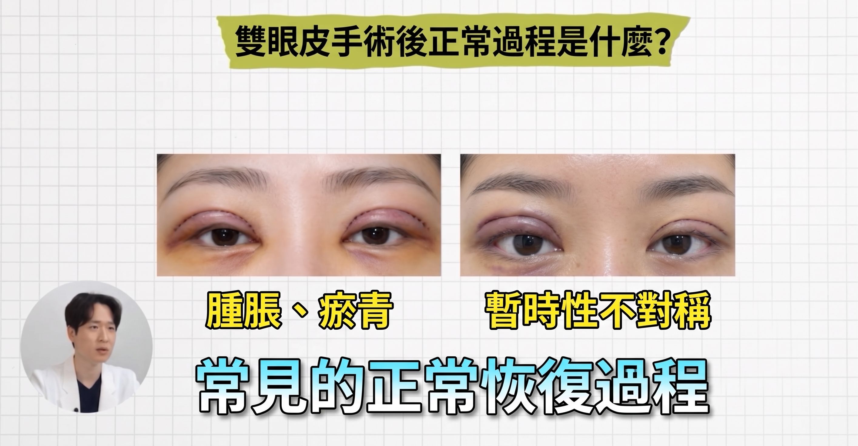 雙眼皮手術後腫脹、瘀青、不對稱是正常恢復還是副作用？1mm整形外科 사진 2