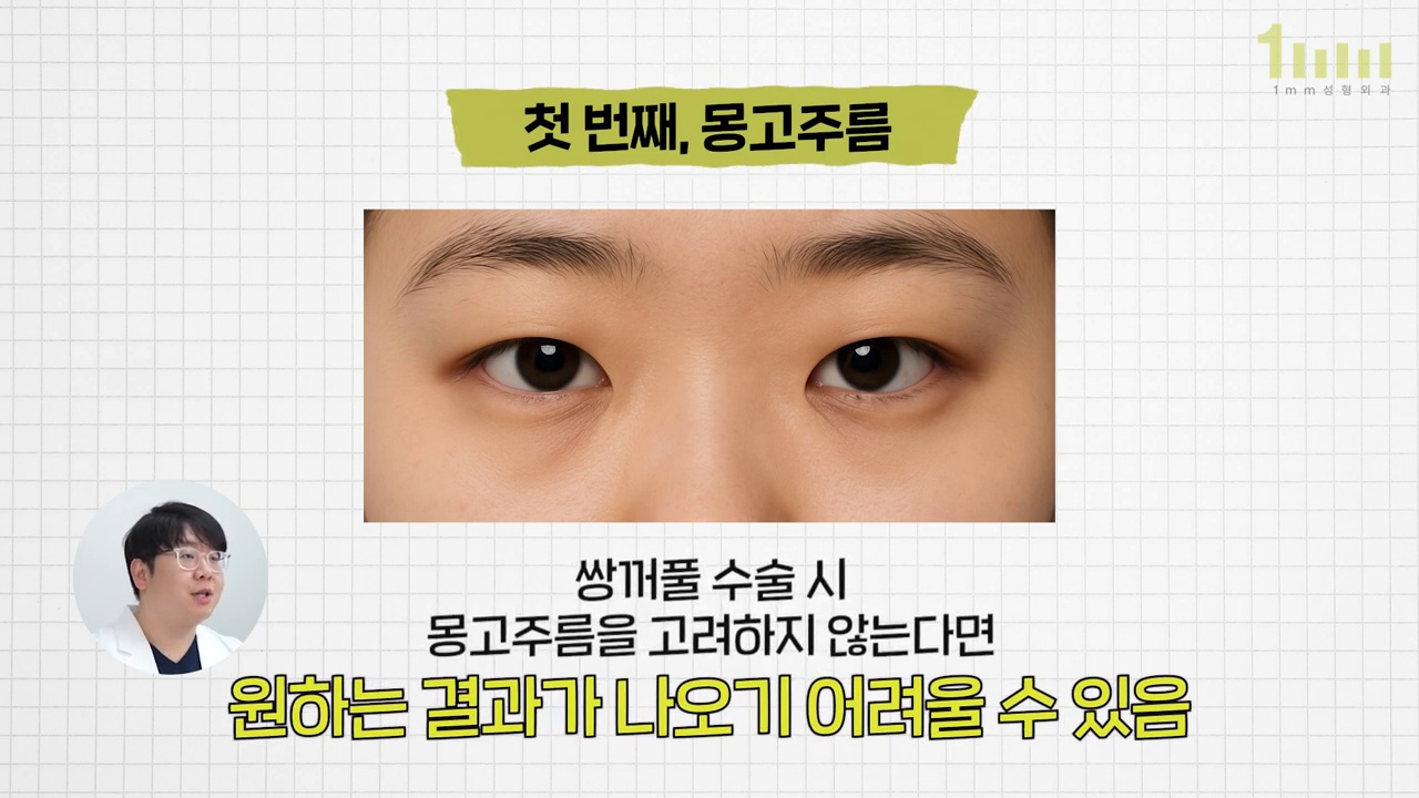 몽고주름이 있는 두 눈을 정면에서 촬영한 이미지와 ‘쌍꺼풀 수술 시 몽고주름을 고려하지 않는다면 원하는 결과가 나오기 어려울 수 있음’ 이라는 영상 자막
