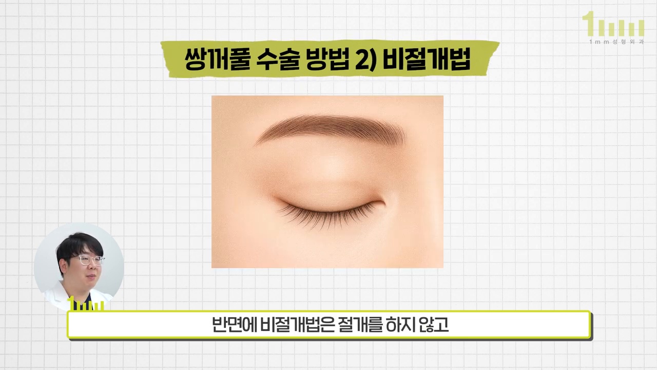 절개선 없이 감은 눈을 보여주는 비절개법 설명 이미지와 ‘반면에 비절개법은 절개를 하지 않고’ 라는 영상 자막
