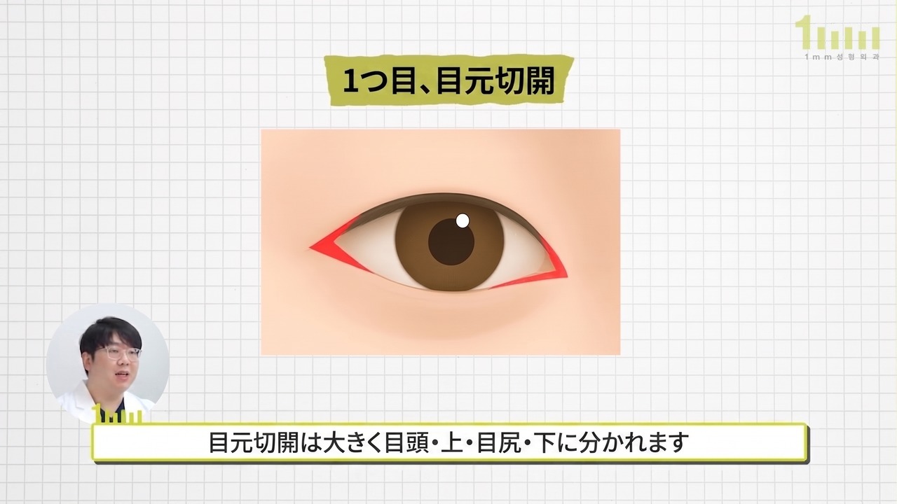 目頭と目尻の方向が赤い三角形で示された目元切開の説明画像と、「目元切開は大きく目頭・上・目尻・下に分かれます」という動画字幕