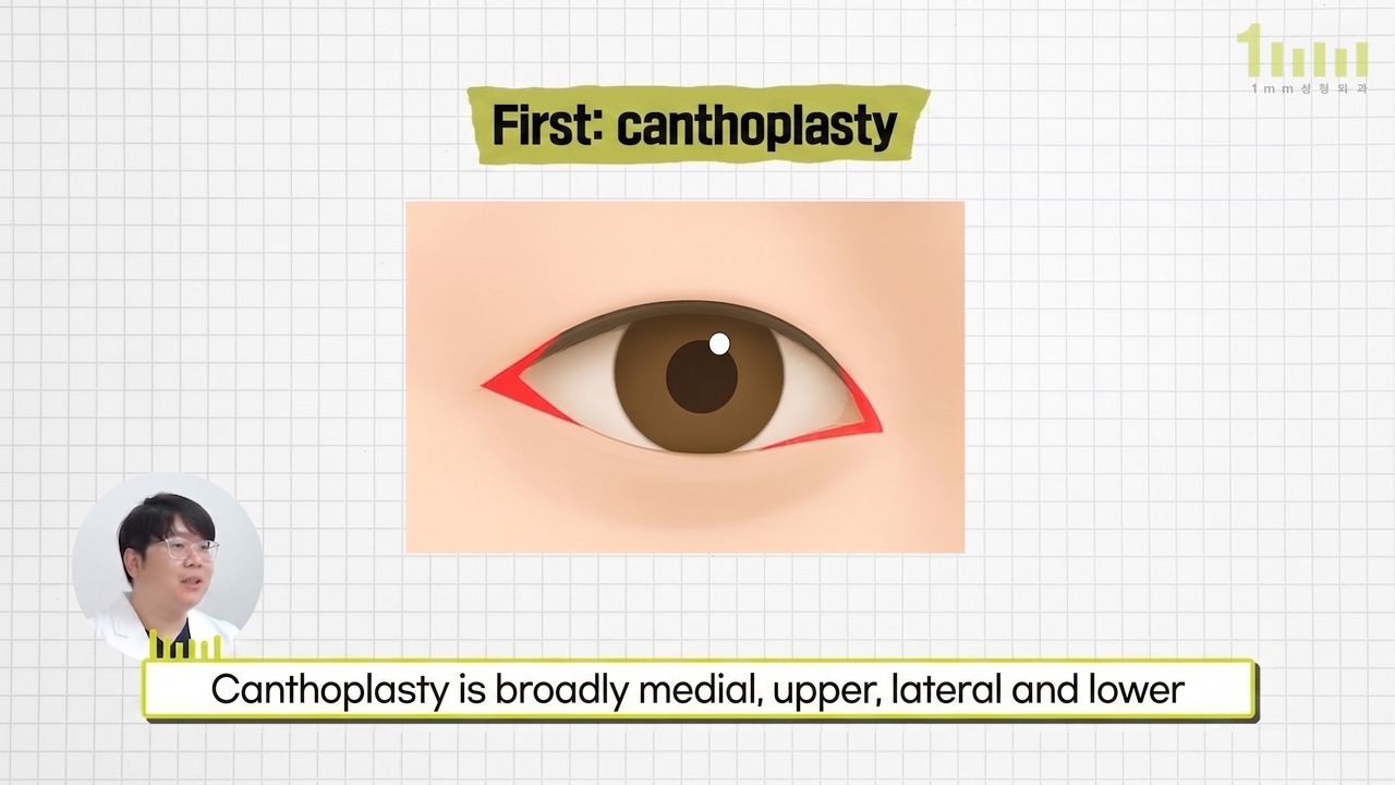 Explanatory image of canthoplasty with the inner and outer corner directions marked by red triangles, with the video subtitle “Canthoplasty is broadly medial, upper, lateral and lower”