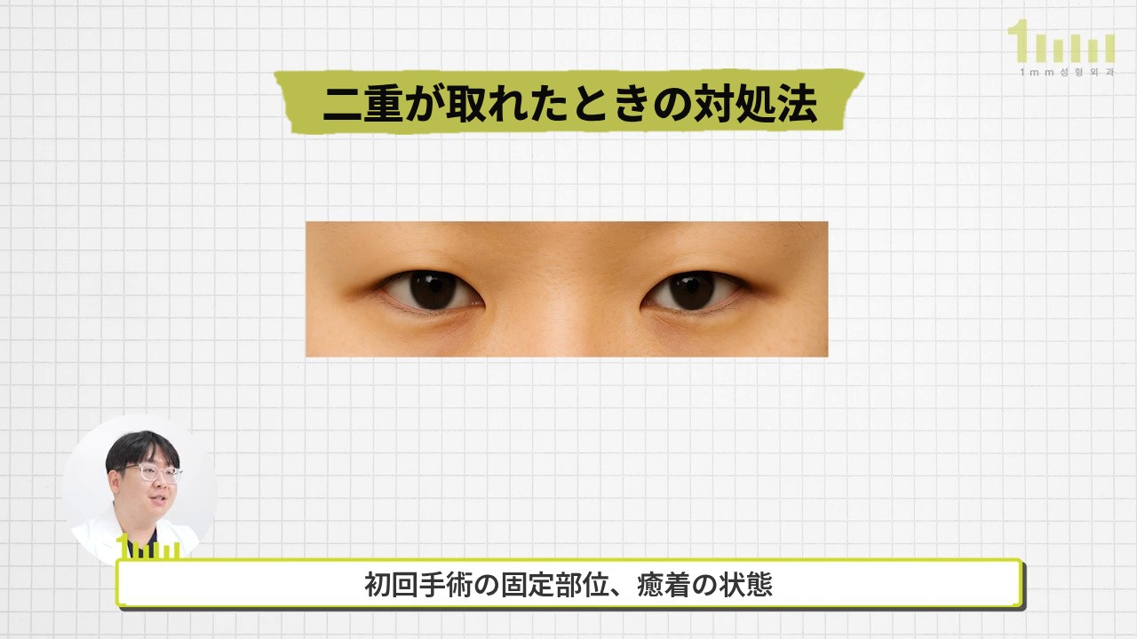 方眼の背景に「二重が取れたときの対処法」というタイトルの下、両目を横長に切り取った写真があり、下に「初回手術の固定部位、癒着の状態」という字幕が表示された動画画面