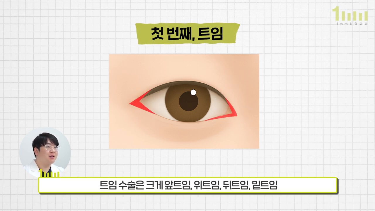 눈의 앞머리와 눈꼬리 방향이 붉은 삼각형으로 표시된 트임 수술 설명 이미지와 ‘트임 수술은 크게 앞트임, 위트임, 뒤트임, 밑트임’ 이라는 영상 자막