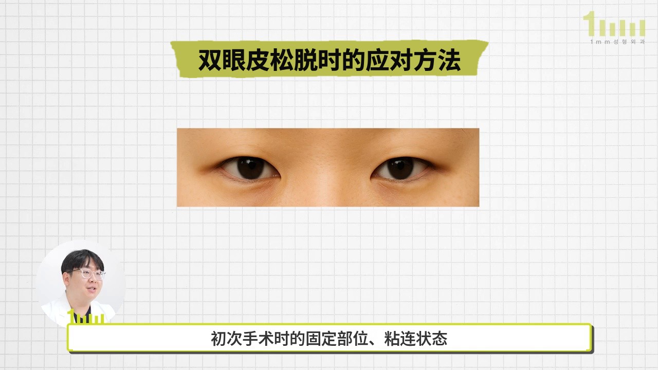 方格背景上，“双眼皮松脱时的应对方法”这一标题下方，有一张横向裁切的双眼照片，下方字幕为“初次手术时的固定部位、粘连状态”的视频画面