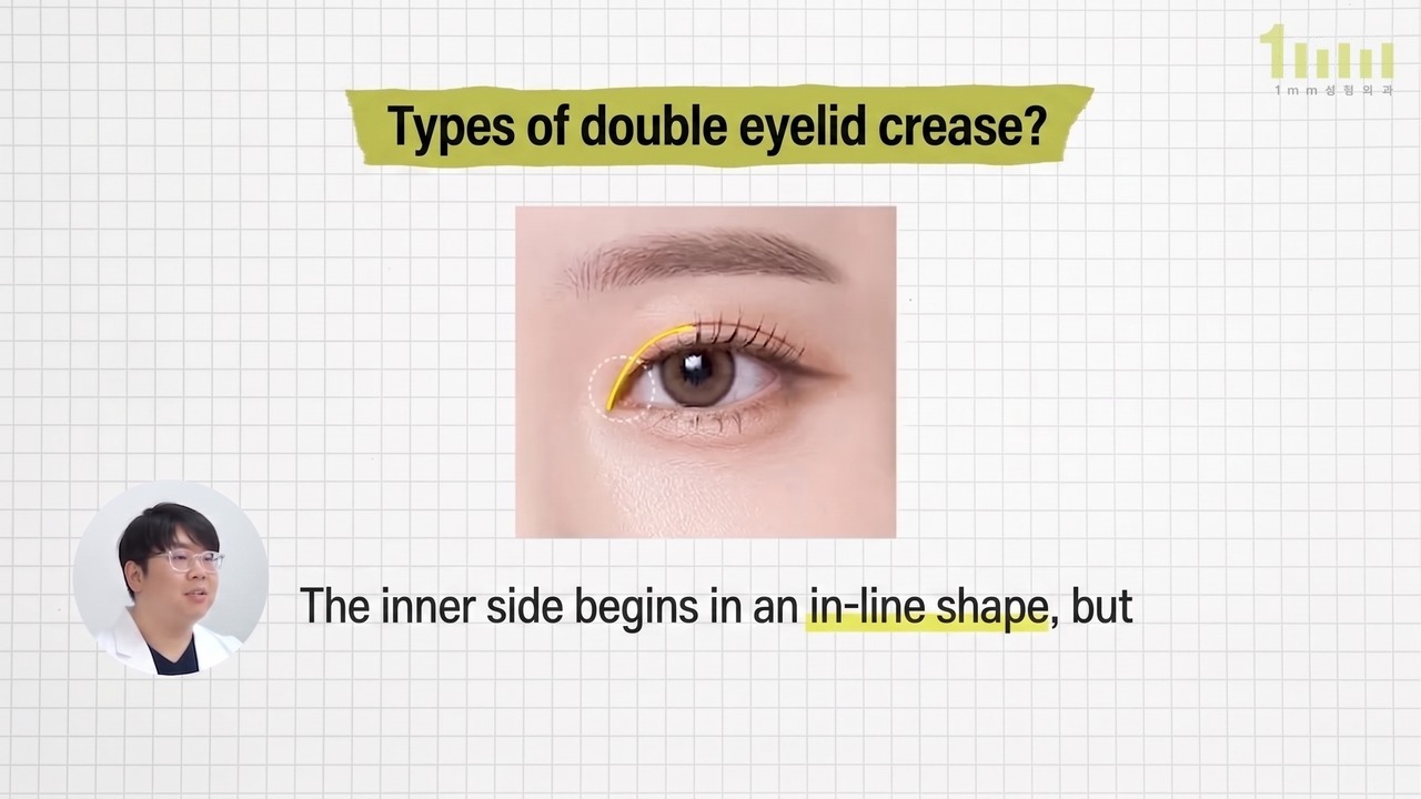 Image with a crease marked by a yellow line starting inside the inner corner of the eye, with the video subtitle “The inner side begins in an in-line shape, but…”