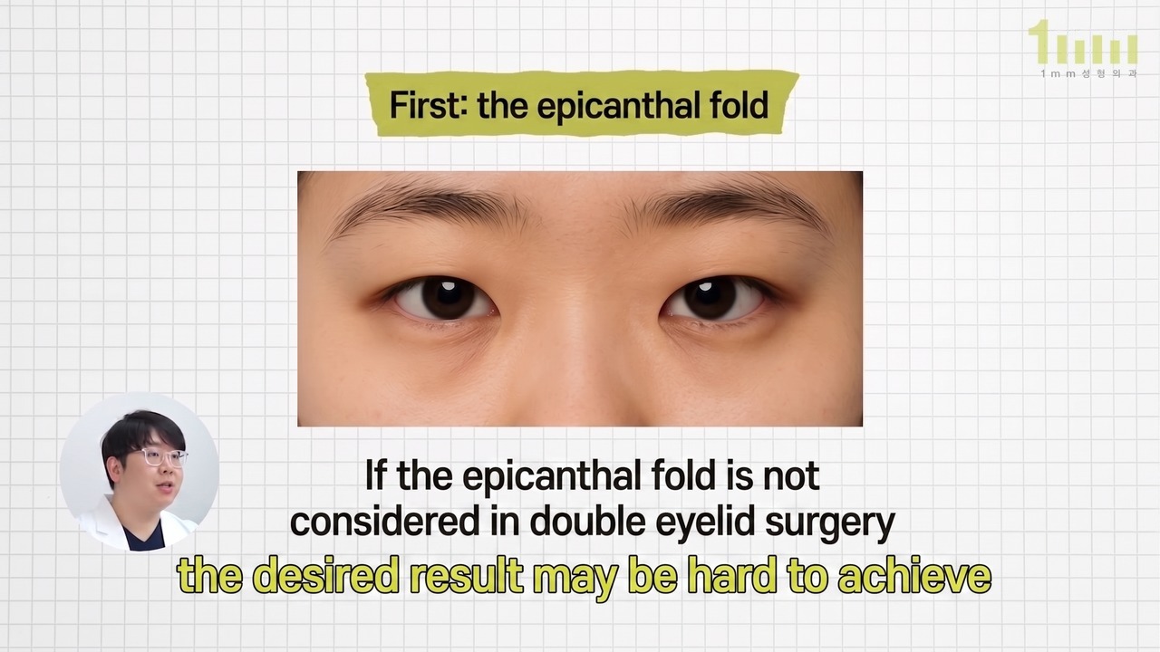 Front-facing photograph of two eyes with epicanthal folds, with the video subtitle “If the epicanthal fold is not considered in double eyelid surgery, the desired result may be hard to achieve”