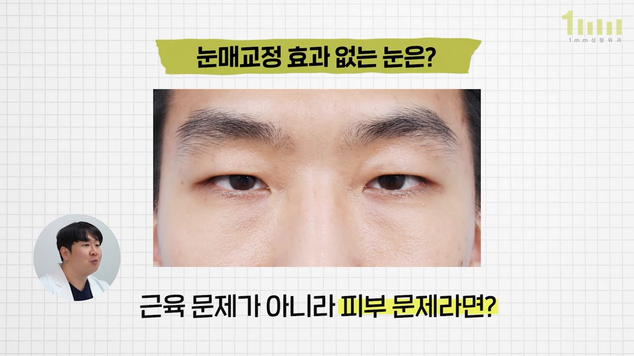 「눈매교정 효과 없는 눈은?」 이라는 제목과 눈꺼풀 피부가 눈동자 위를 덮고 있는 눈 클로즈업이 놓인 영상 설명 화면