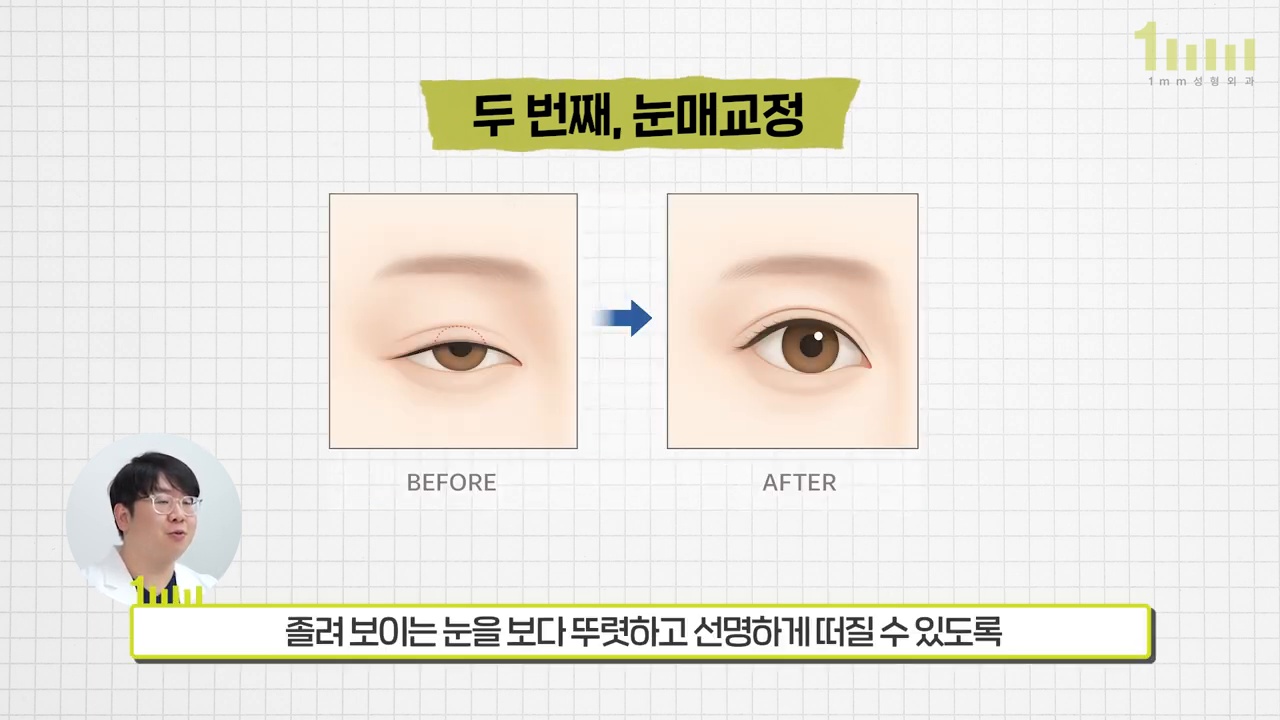눈매교정의 개념을 설명하는 전후 비교 일러스트와 ‘졸려 보이는 눈을 보다 뚜렷하고 선명하게 떠질 수 있도록’ 이라는 영상 자막