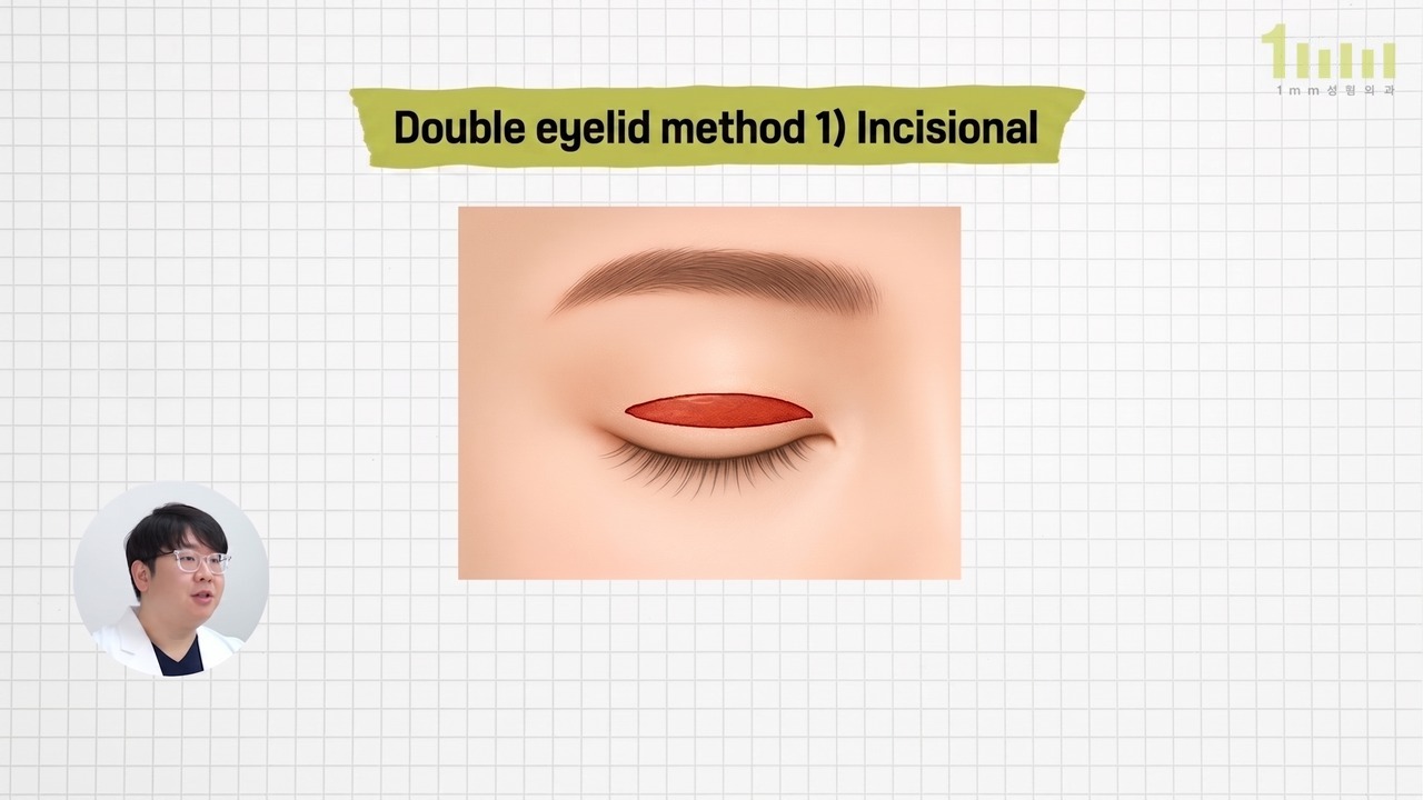 Explanatory image of the incisional method, with the incision area marked in red on the upper eyelid