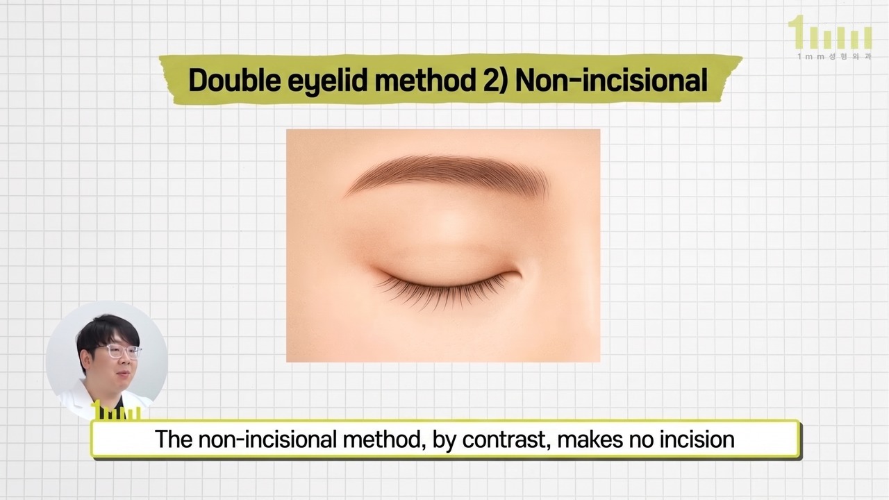 Explanatory image of the non-incisional method showing a closed eye with no incision line, with the video subtitle “The non-incisional method, by contrast, makes no incision”
