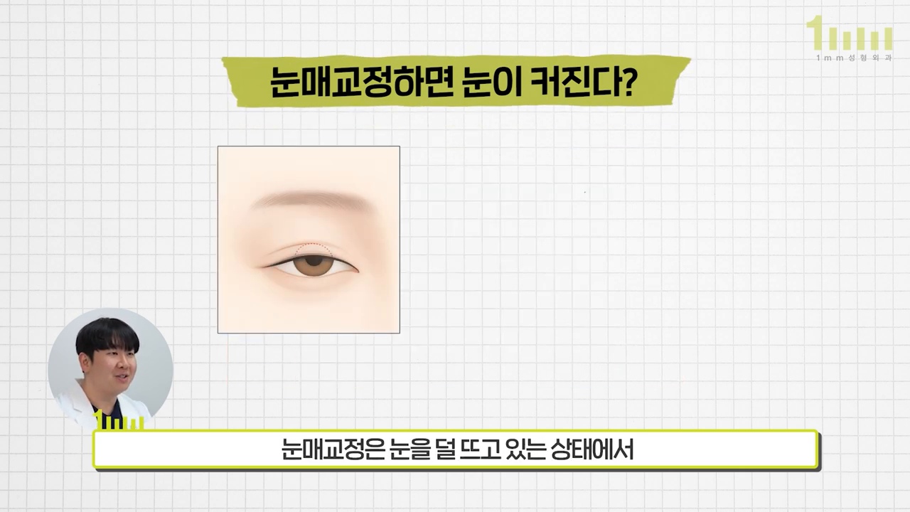 「눈매교정하면 눈이 커진다?」 라는 제목과 눈꺼풀 구조를 그린 일러스트가 놓인 영상 설명 화면