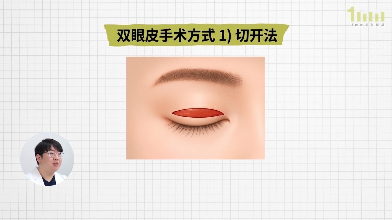 上眼皮切开范围以红色区域标示的切开法说明图