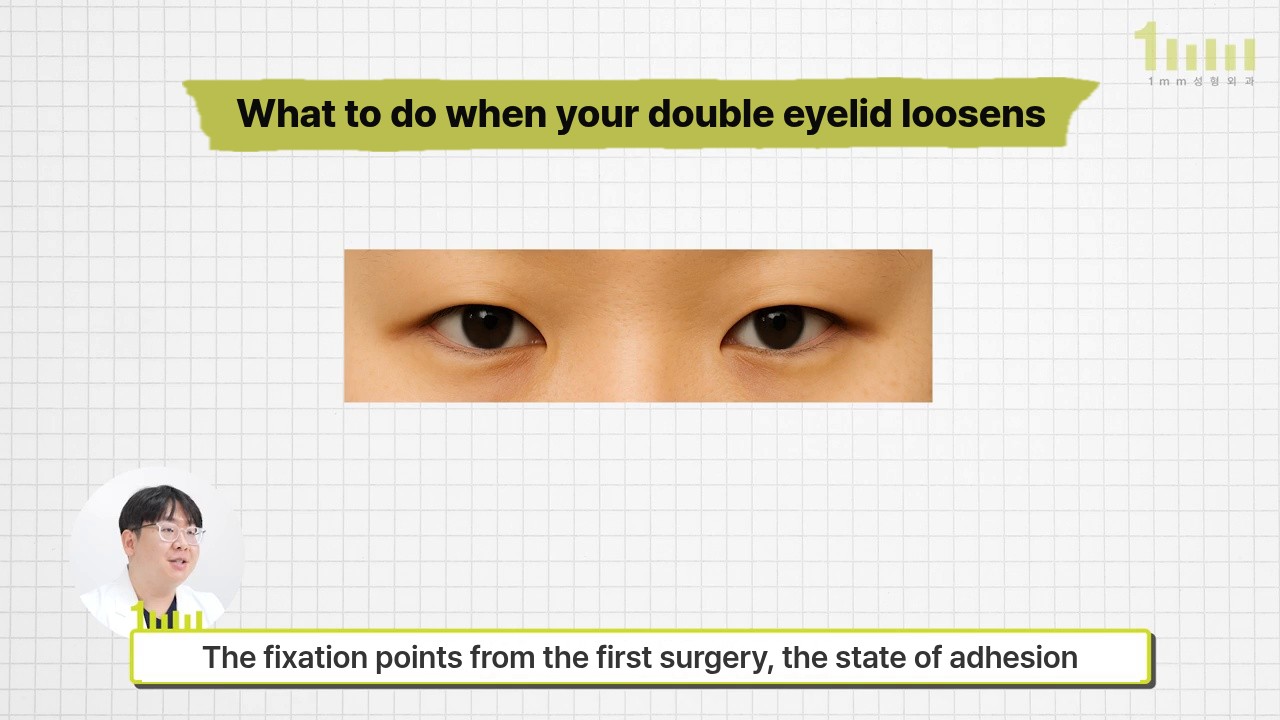 Video screen on a grid background: under the title ‘What to do when your double eyelid loosens’ is a wide strip photo of two eyes, with the subtitle ‘The fixation points from the first surgery, the state of adhesion’ below
