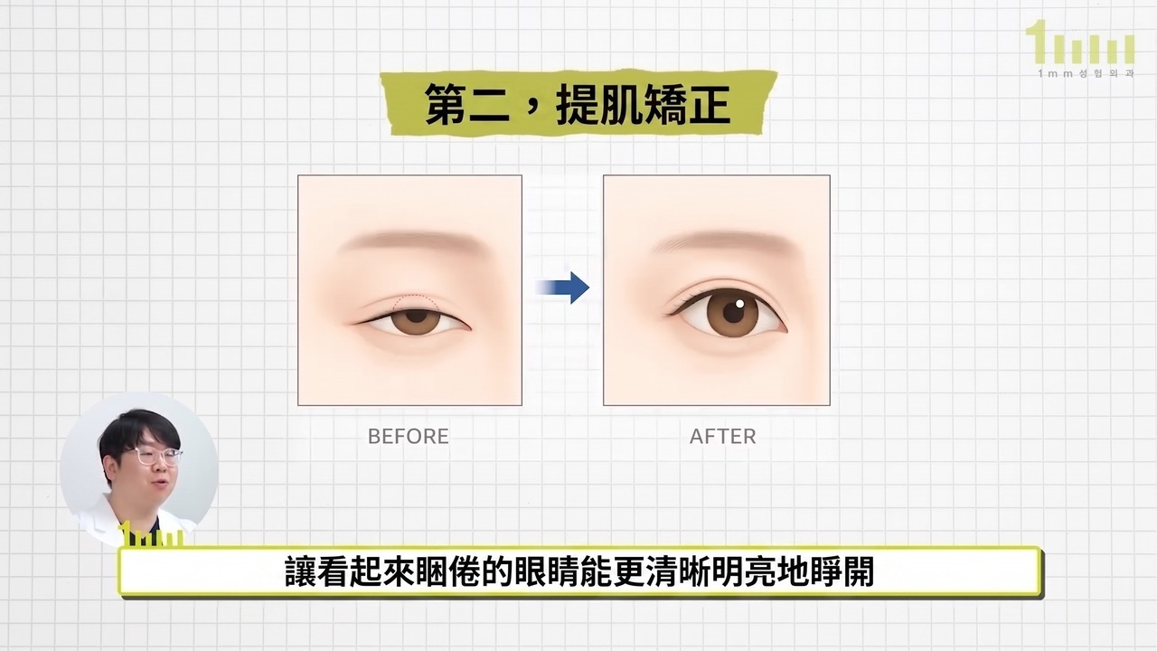 說明提肌矯正概念的前後對比插圖，配有影片字幕「讓看起來睏倦的眼睛能更清晰明亮地睜開」