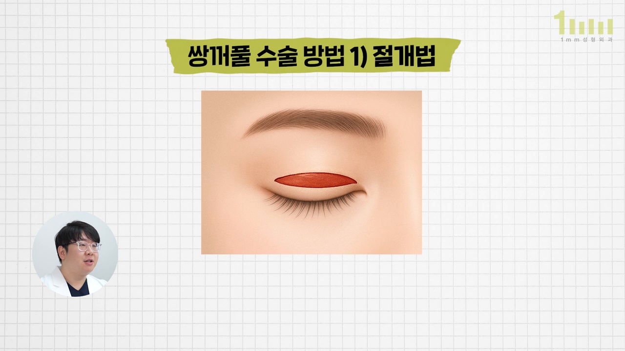 눈꺼풀 위쪽에 절개 범위가 붉은 영역으로 표시된 절개법 설명 이미지