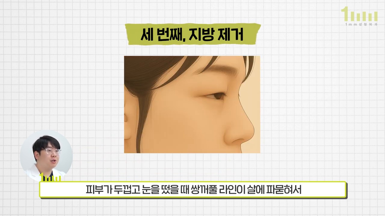 옆에서 본 눈두덩이 두툼한 얼굴 일러스트와 ‘피부가 두껍고 눈을 떴을 때 쌍꺼풀 라인이 살에 파묻혀서’ 라는 영상 자막